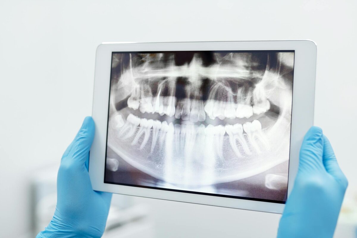 periodontal disease
