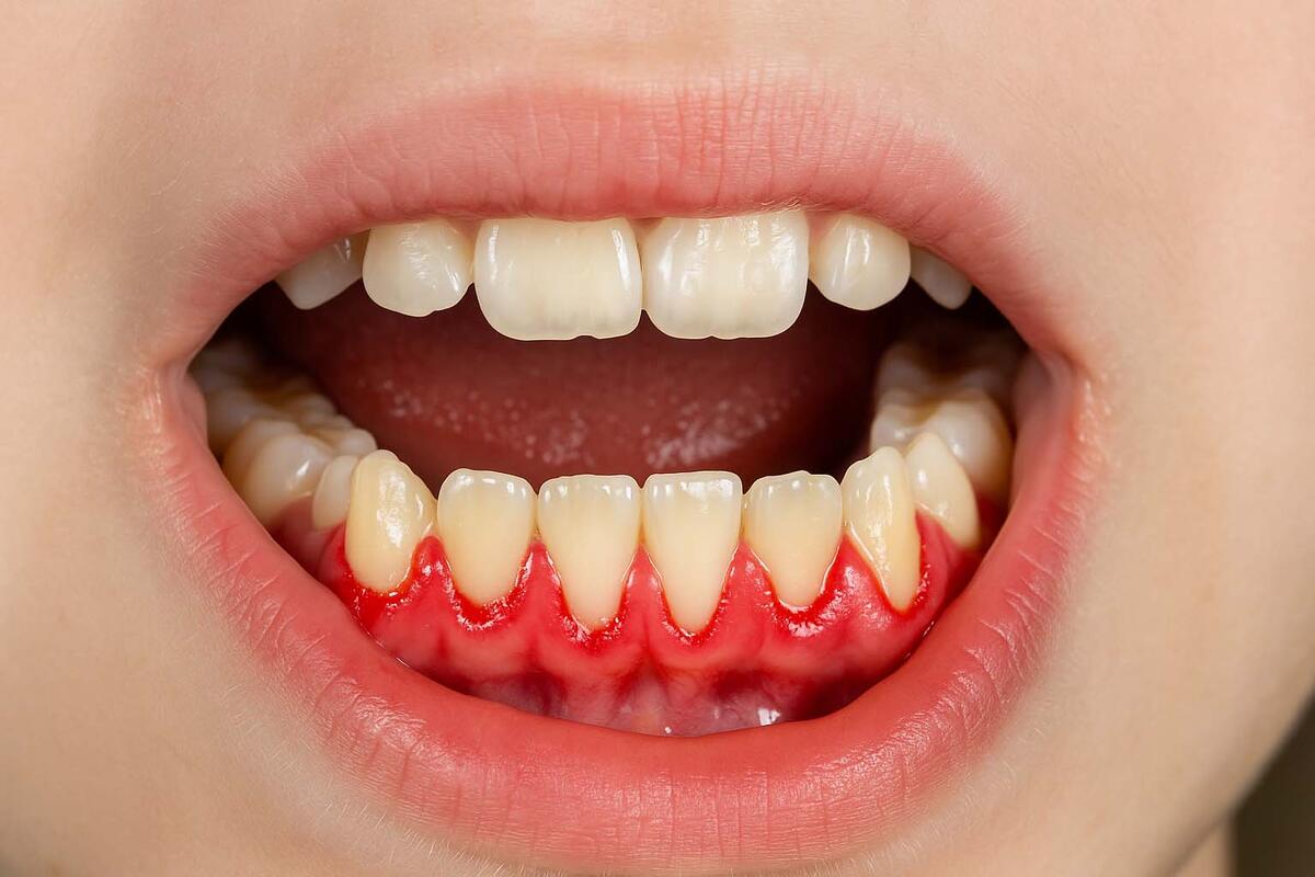 what is periodontitis